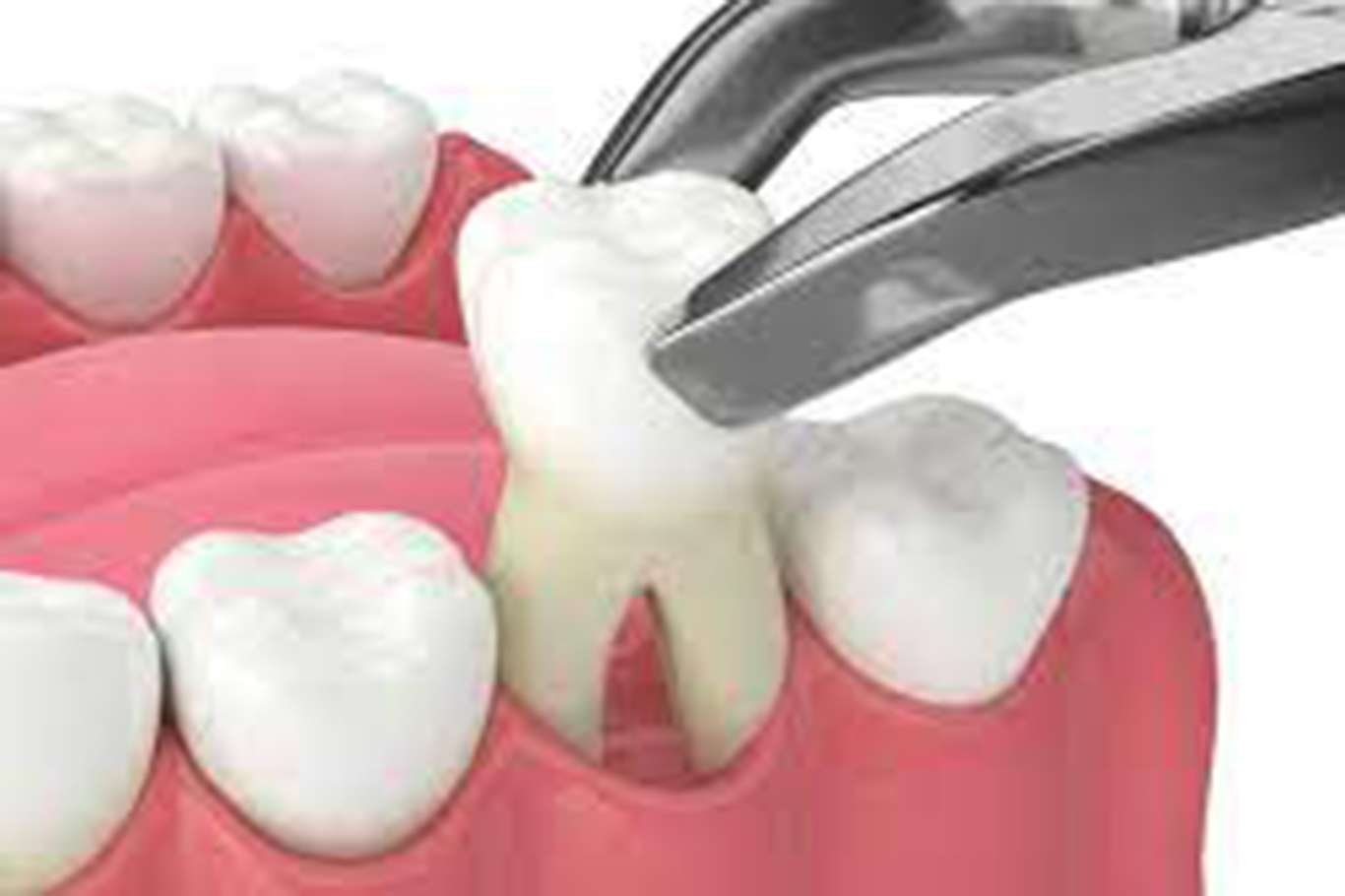 Diş kaybı ile gelen sorunlara dikkat!