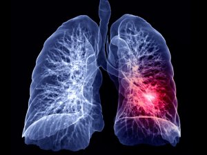 Akciğer embolisi riski taşıyor olabilirsiniz  