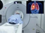 Uzmanlar: Akciğer kanseri görülme yaşı gittikçe düşüyor  