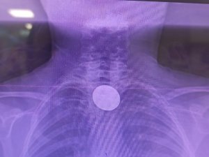 Siirt’te küçük çocuğun yuttuğu madeni para başarılı operasyonla çıkarıldı